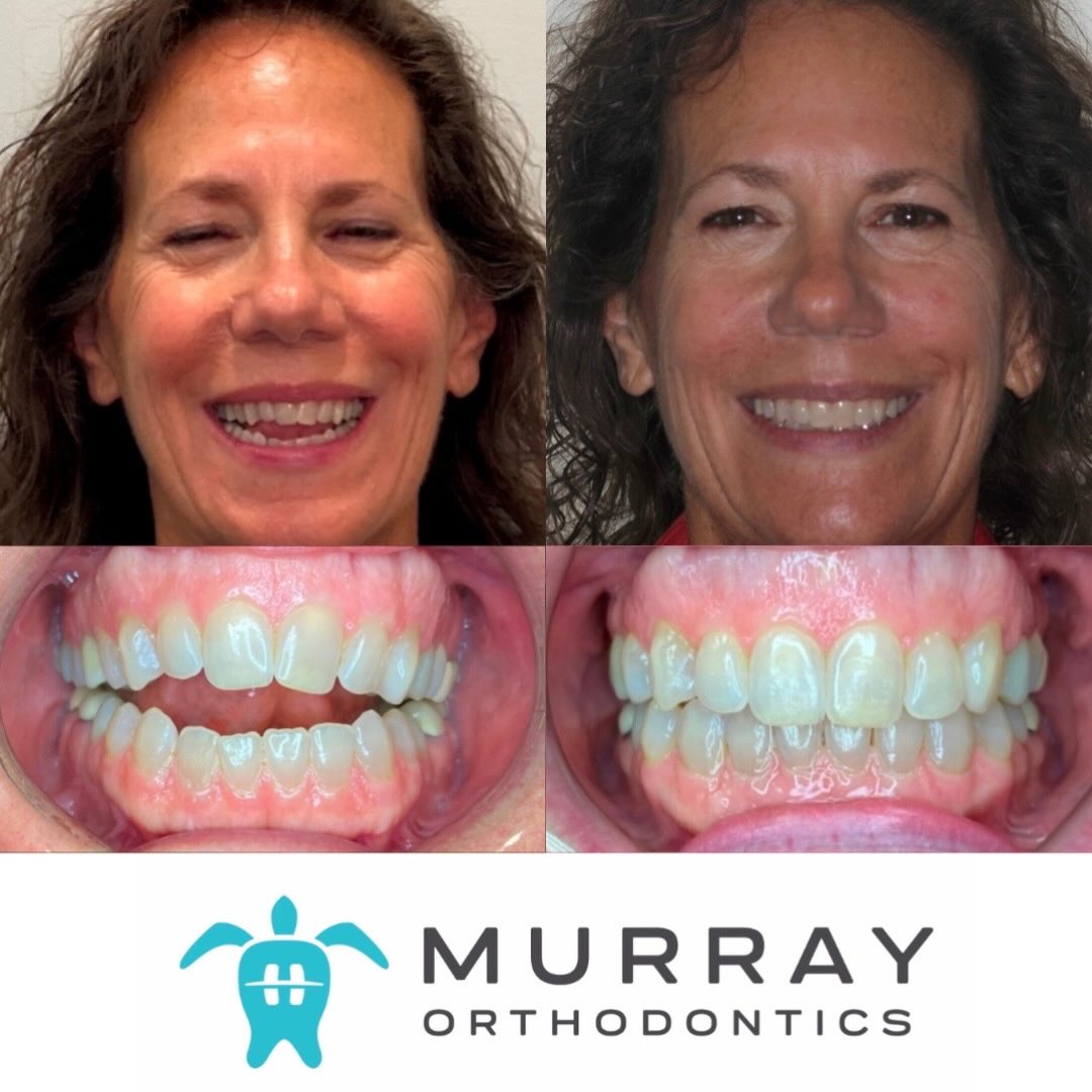Clear aligners in Palm Beach Gardens before and after results at Murray Orthodontics in Palm Beach Gardens showing anterior open bite correction without surgery