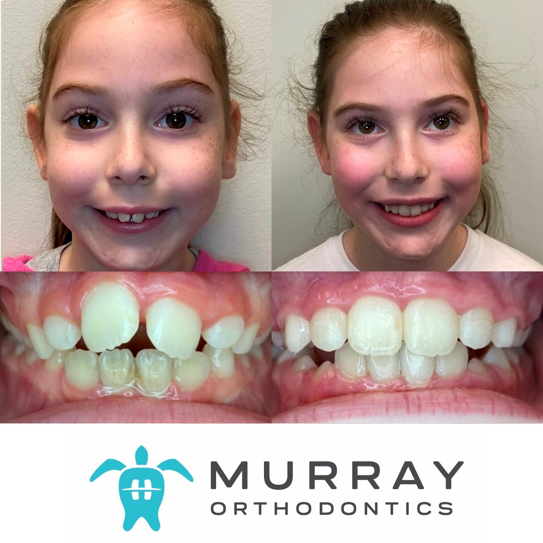 Airway orthodontics in Palm Beach Gardens — before and after crossbite correction in a child patient at Murray Orthodontics