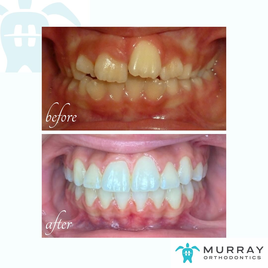 Before and after braces near Wellington, FL — crowding and bite correction by Dr. Murray at Murray Orthodontics