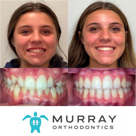 Orthodontist West Palm Beach — before and after braces results at Murray Orthodontics showing corrected crowding and a confident new smile