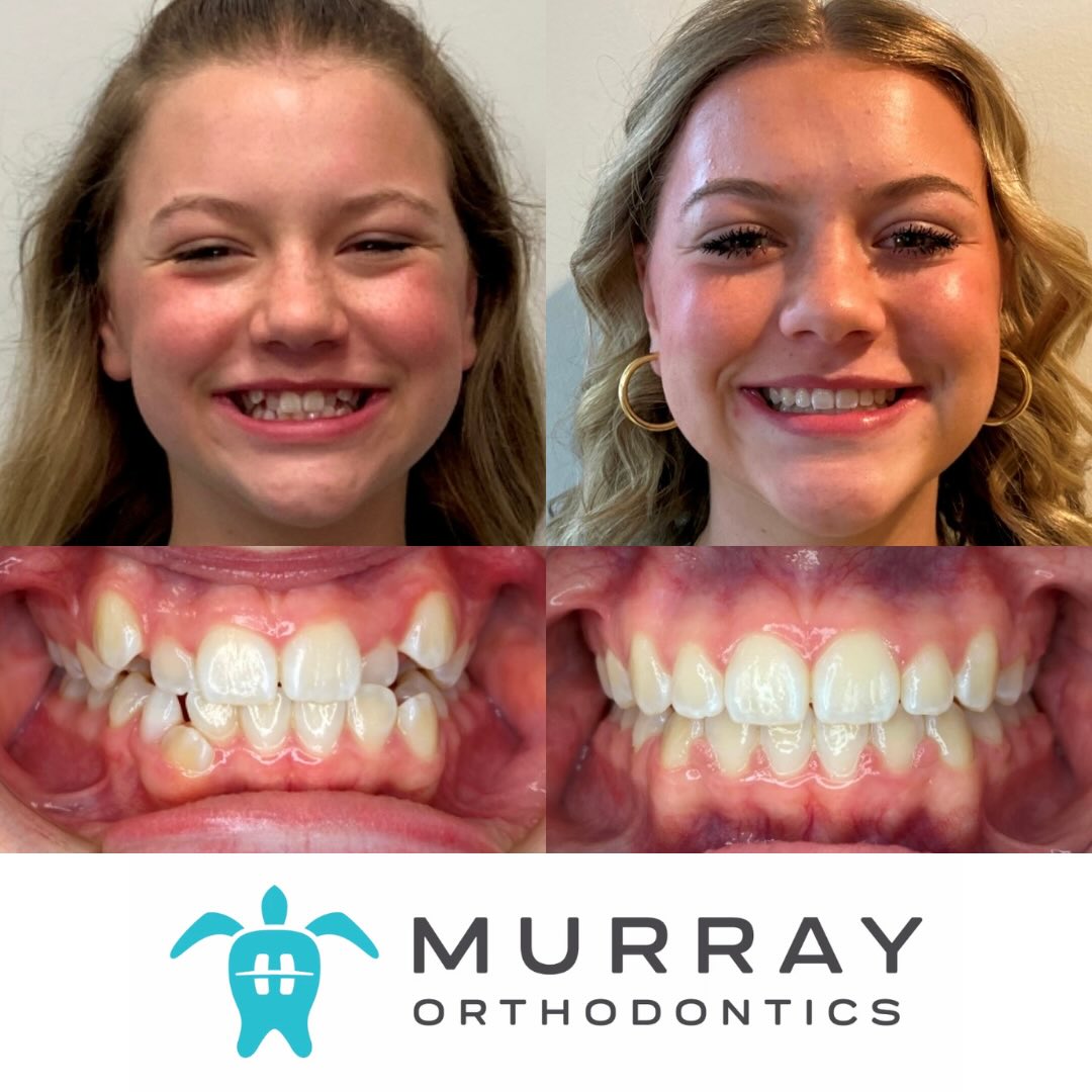Teen patient before and after metal braces at Murray Orthodontics in Palm Beach Gardens showing correction of crowded teeth and improved smile