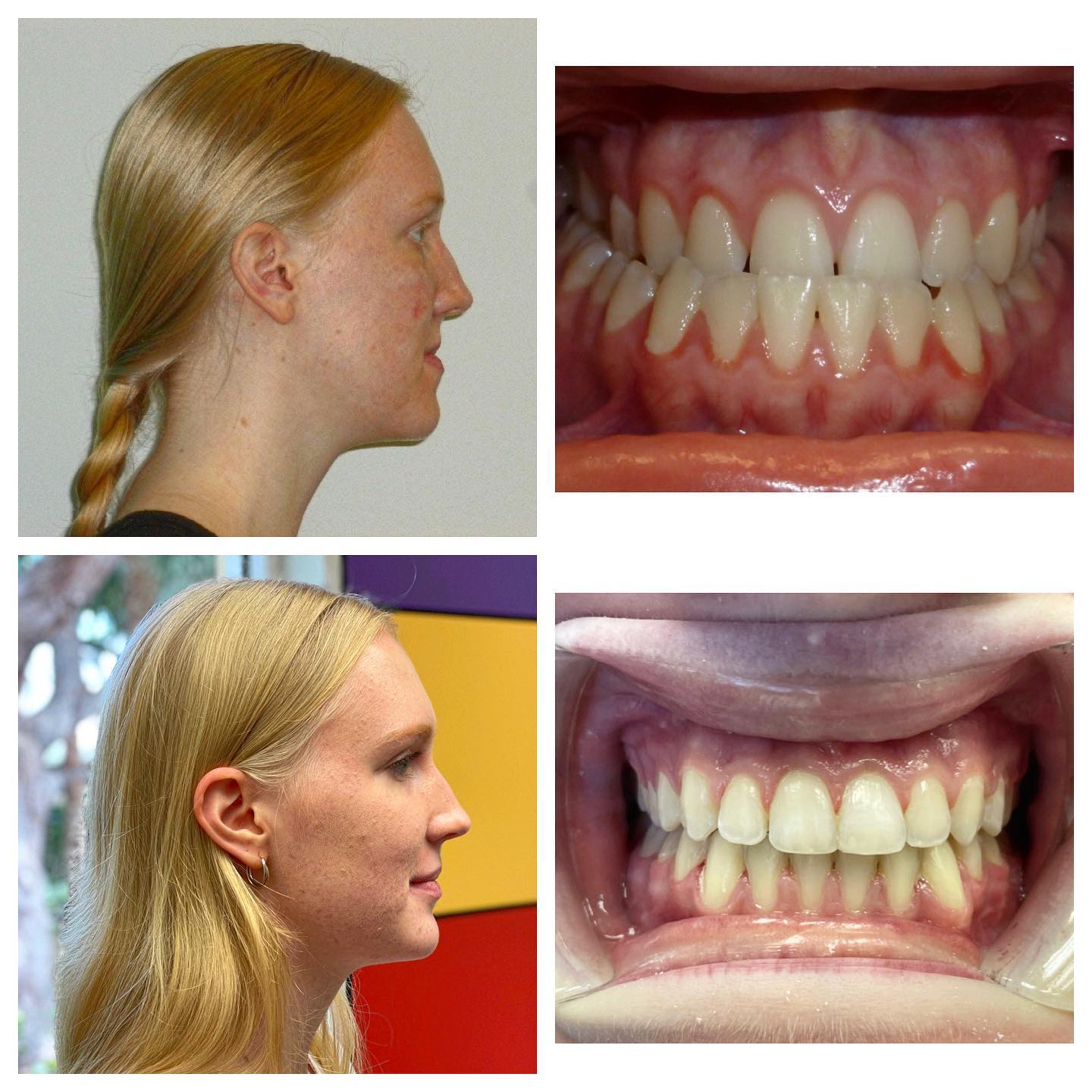 Before and after photos showing underbite correction with profile view and bite alignment improvement after orthodontic treatment