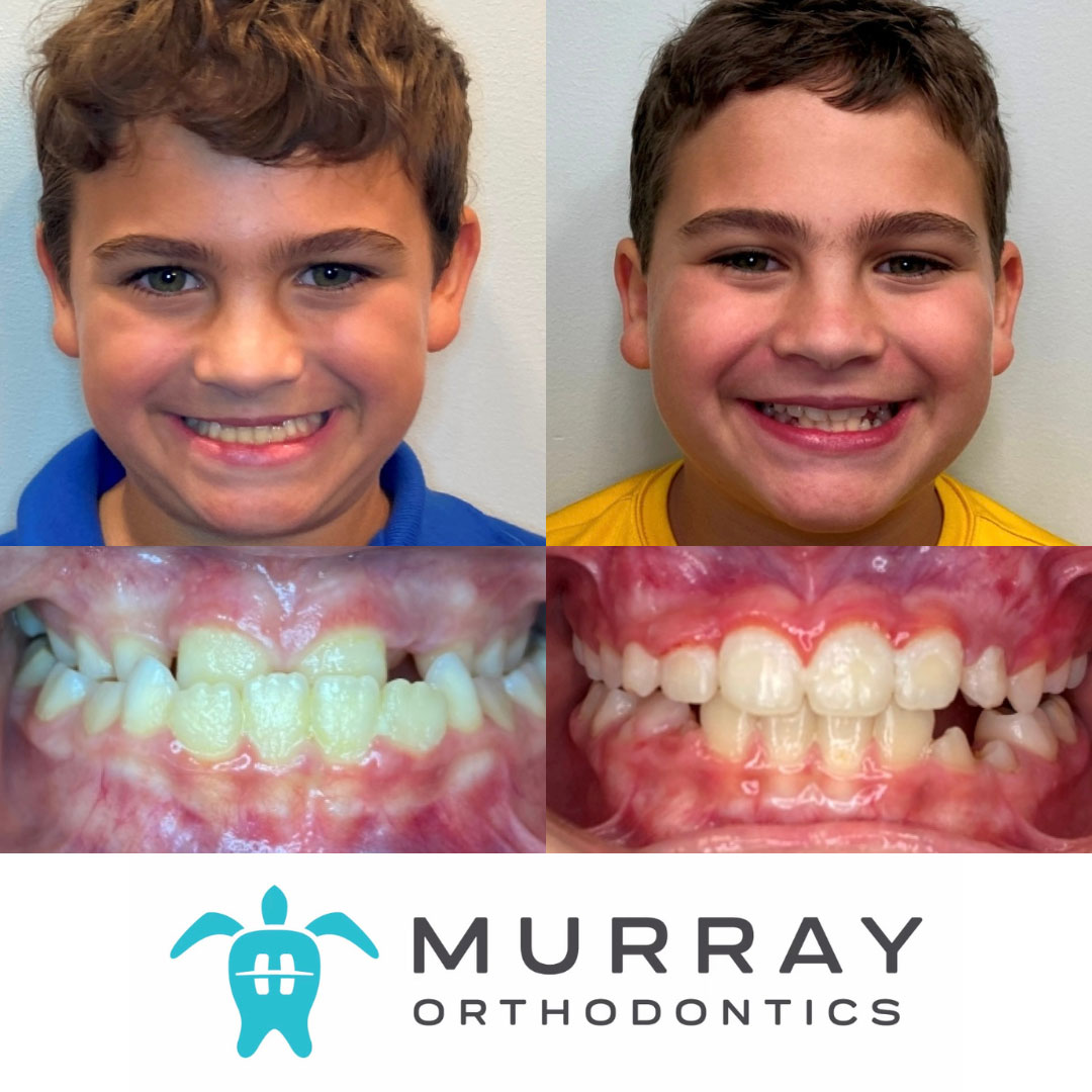 efore and after underbite treatment in Palm Beach Gardens — young patient's bite correction results at Murray Orthodontics