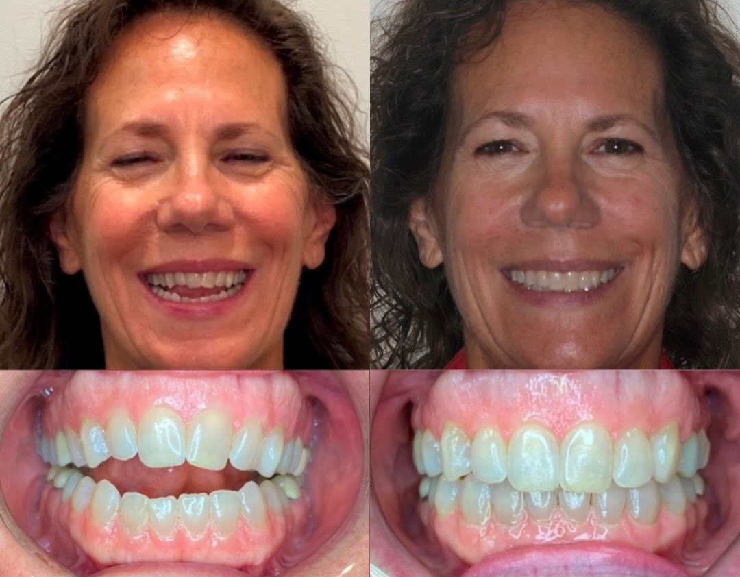  Adult open bite before and after — corrected with clear aligners at Murray Orthodontics in Palm Beach Gardens, no surgery or extractions needed