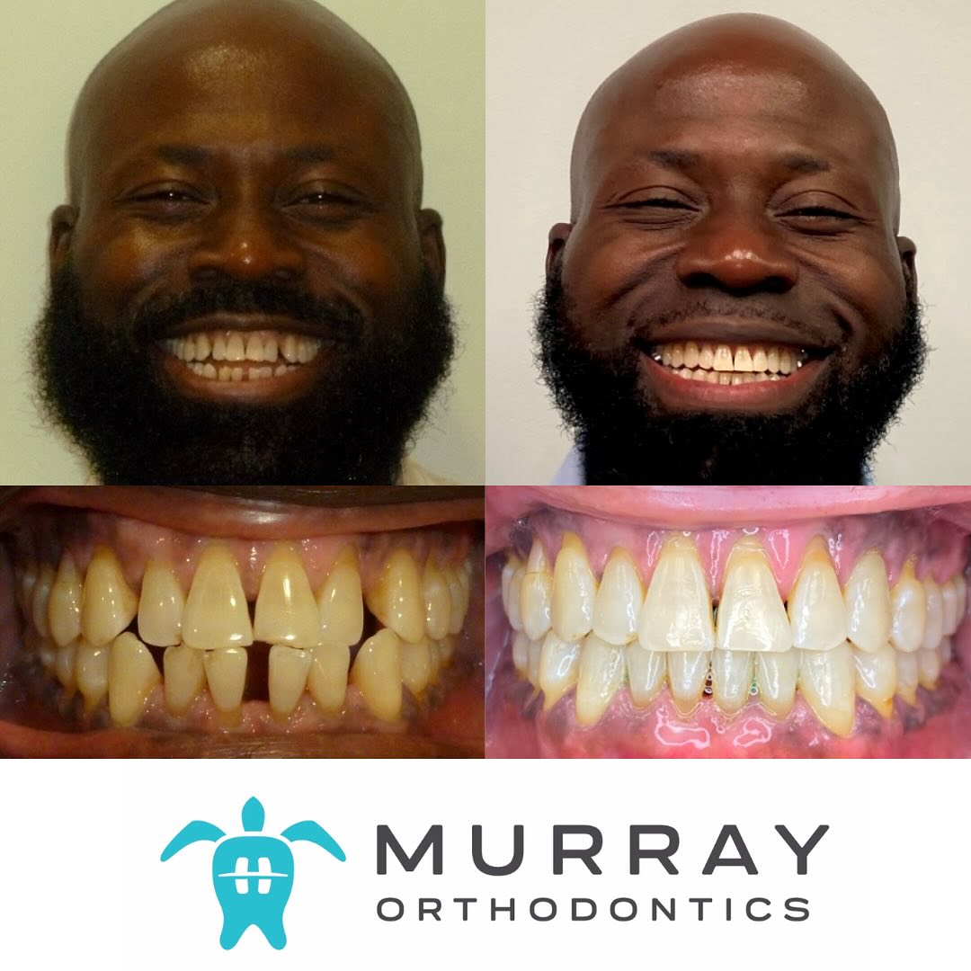 Lochard's Invisalign before and after results at Murray Orthodontics Royal Palm Beach — traumatic occlusion corrected with clear aligners