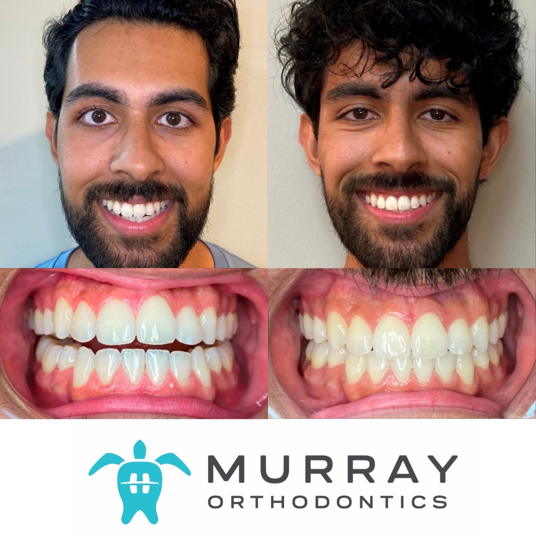 Open bite treatment in Palm Beach Gardens — before and after clear aligner results at Murray Orthodontics, completed in 15 months