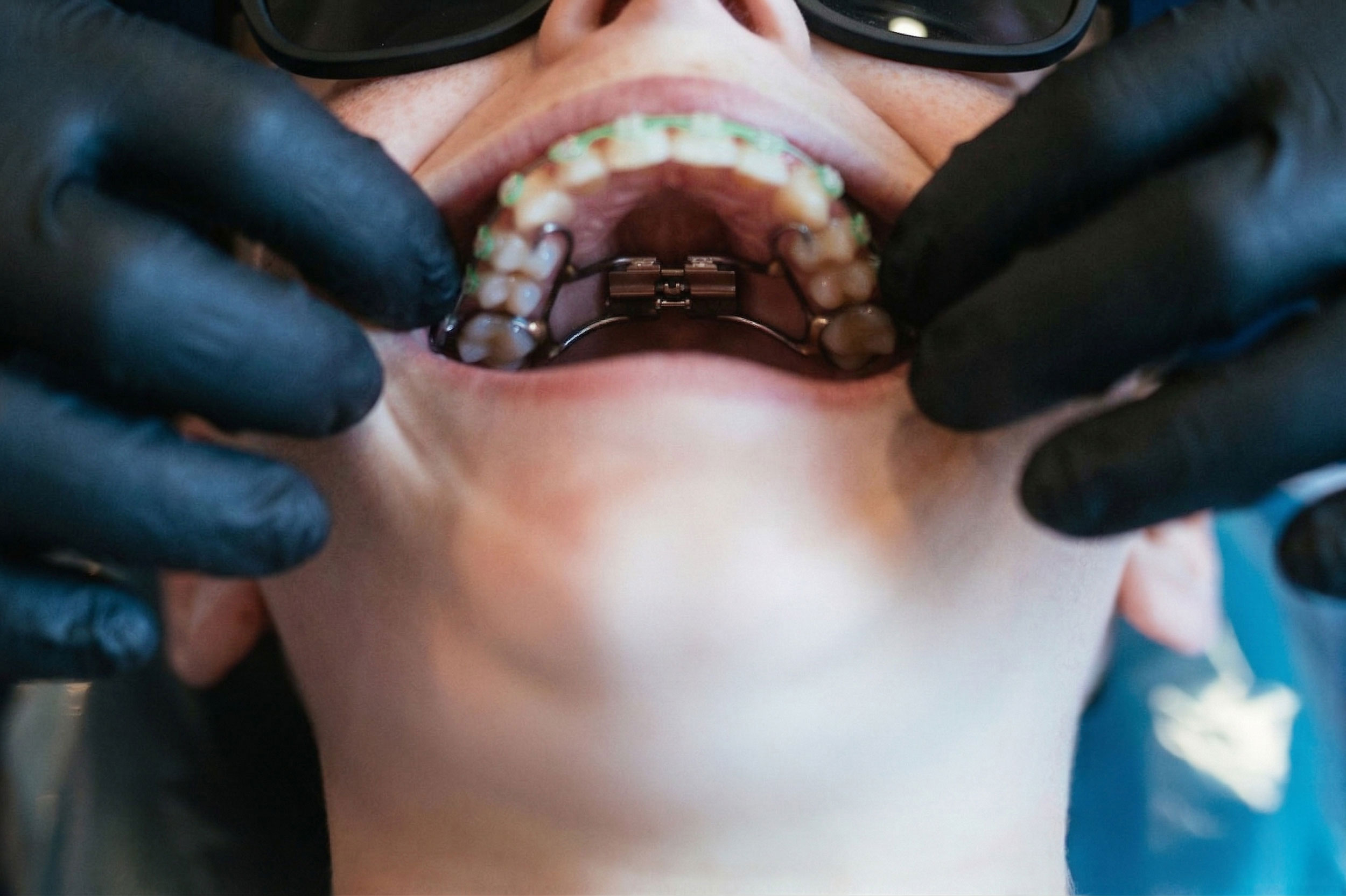 Palate expander cemented in child's mouth at Murray Orthodontics in Palm Beach Gardens