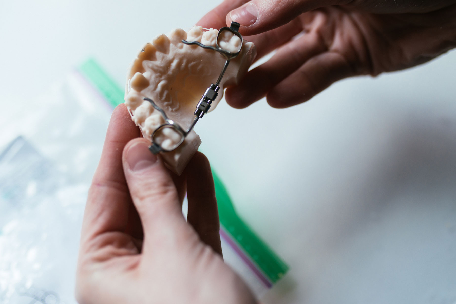 Hyrax palate expander on dental model at Murray Orthodontics in Palm Beach Gardens