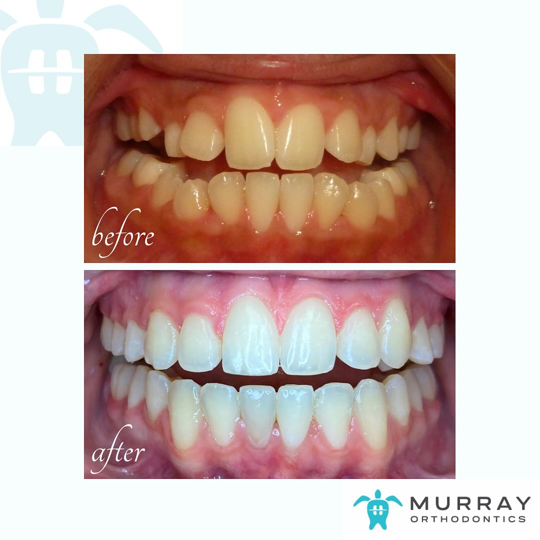 Before and after braces for adult teeth crowding at Murray Orthodontics near Jupiter FL showing straighter aligned smile