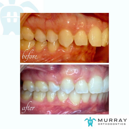 Before and after overjet and overbite correction at Murray Orthodontics in Palm Beach Gardens, FL