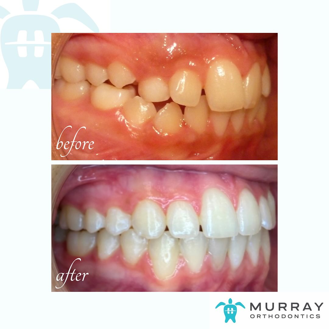 Braces Cost in Royal Palm Beach — before and after treatment results at Murray Orthodontics