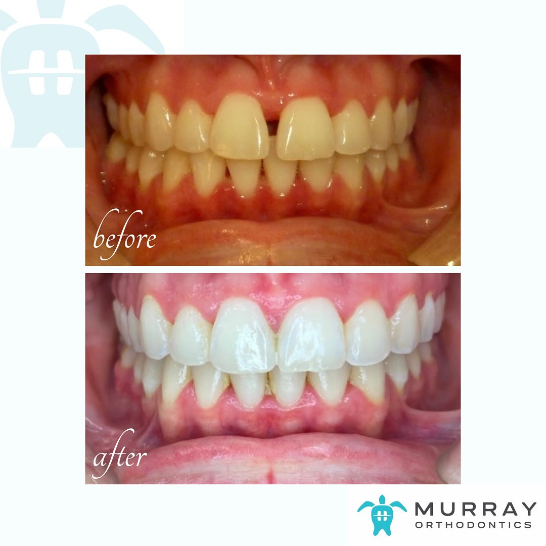 Invisalign before and after results showing closed front gap and aligned teeth for Rainey, a teen patient at Murray Orthodontics in Palm Beach Gardens