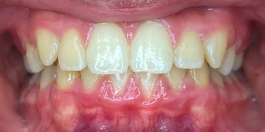 Same child's front teeth after Phase 1 braces corrected the crossbite, with the bite aligned and gums recovering, at Murray Orthodontics in Palm Beach Gardens
