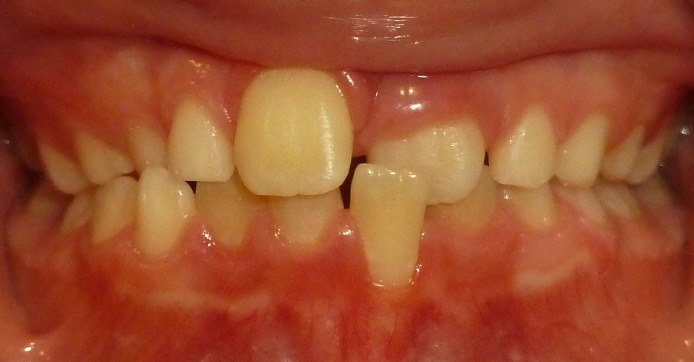 Child's anterior crossbite with early gum recession on a lower front tooth before Phase 1 treatment at Murray Orthodontics in Palm Beach Gardens