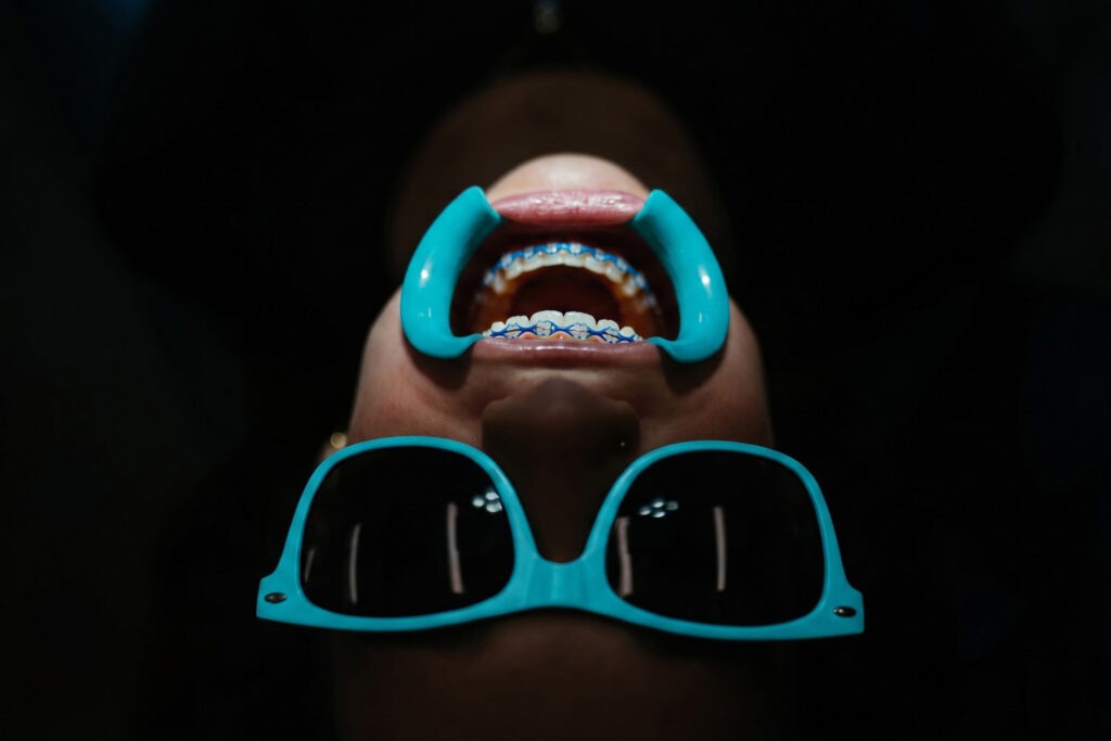 Close-up of clear ceramic braces with blue elastic ties at Murray Orthodontics in Palm Beach Gardens, FL