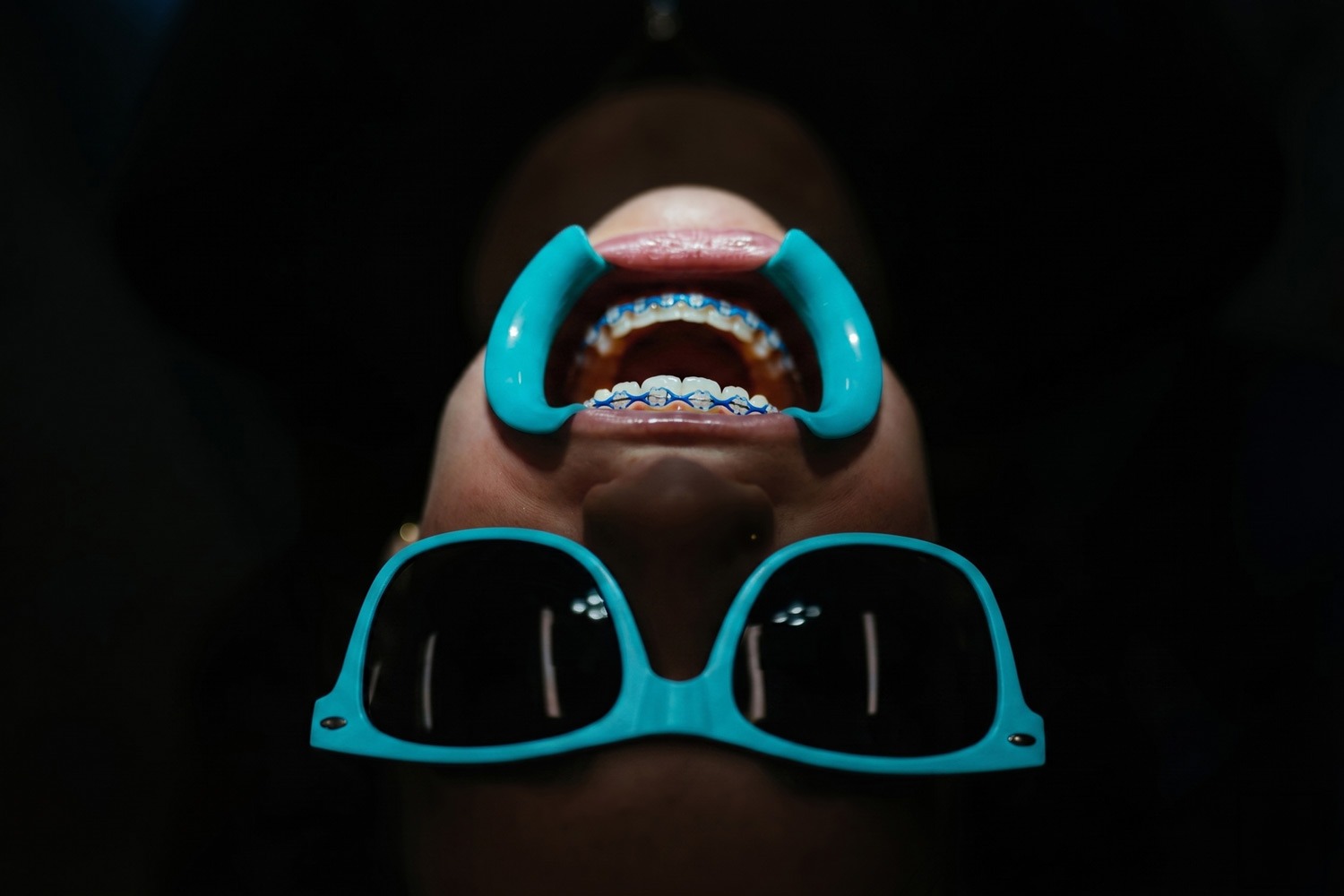 Close-up of clear ceramic braces with blue elastic ties at Murray Orthodontics in Palm Beach Gardens, FL