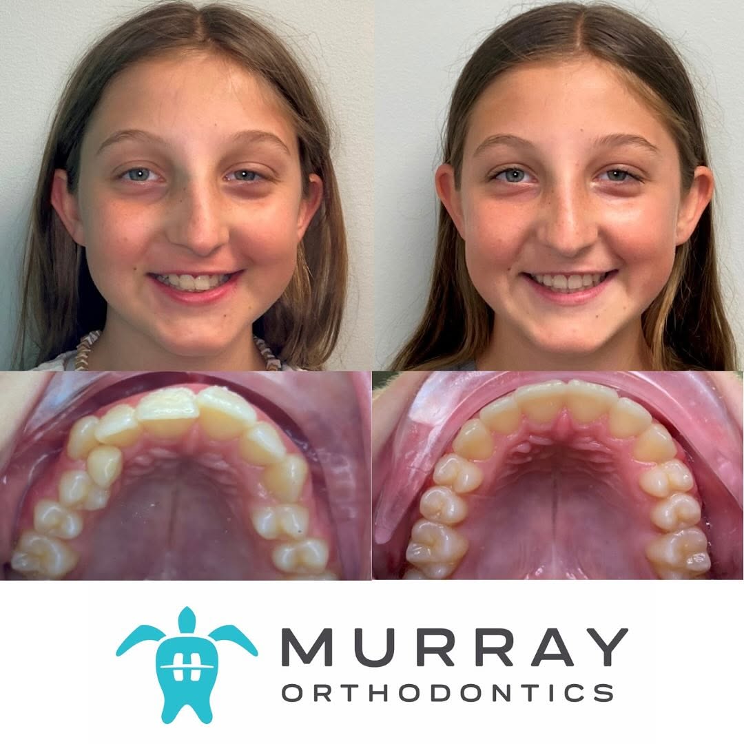 Before and after of a teen's crowded upper teeth straightened at Murray Orthodontics in Palm Beach Gardens