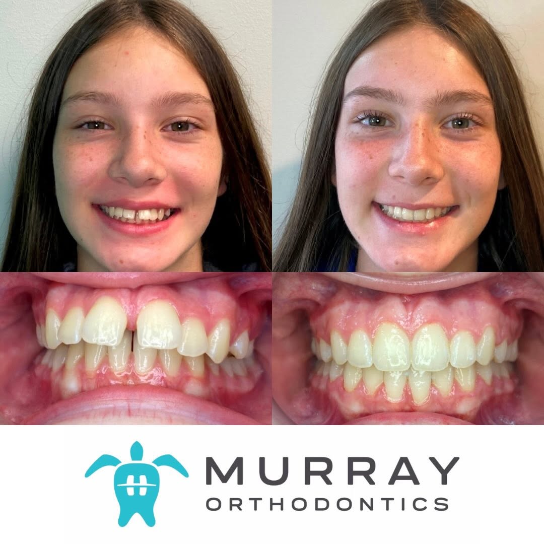 Before and after orthodontic treatment at Murray Orthodontics in Palm Beach Gardens showing a teen patient's gaps closed and teeth aligned