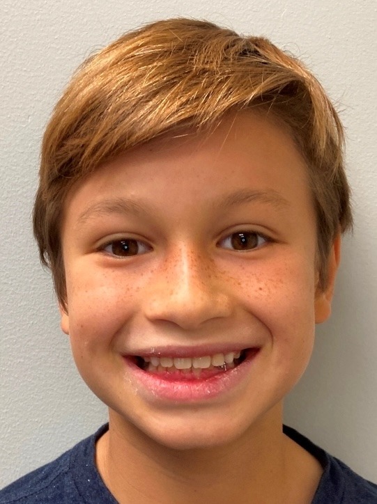 Same boy smiling with an aligned bite after completing Phase 1 braces at Murray Orthodontics in Palm Beach Gardens