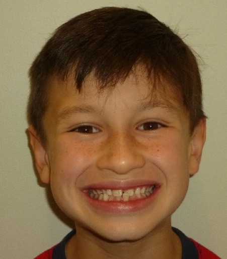 Young boy smiling before Phase 1 orthodontic treatment for a crossbite at Murray Orthodontics in Palm Beach Gardens