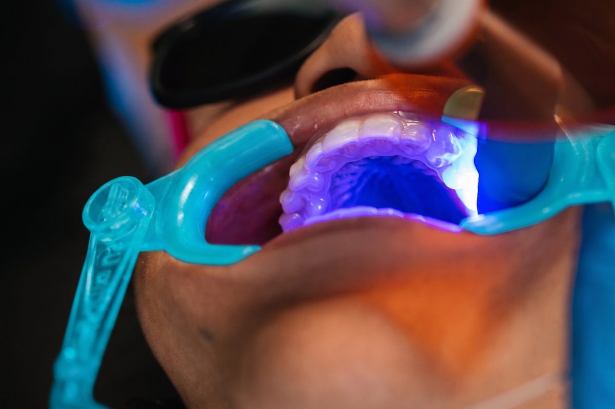 Invisalign attachments being placed on a patient's upper teeth with a clear template tray and curing light at Murray Orthodontics in Palm Beach Gardens