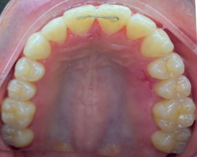 Bonded retainer wire behind the upper front teeth holding a closed gap after clear aligner treatment in Palm Beach Gardens