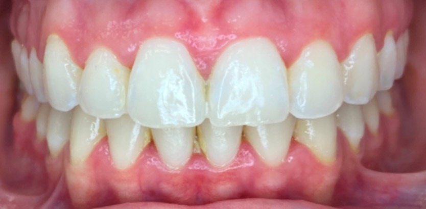 The same front teeth after eight months of clear aligners, with the gap closed and the midlines matched, at Murray Orthodontics in Palm Beach Gardens