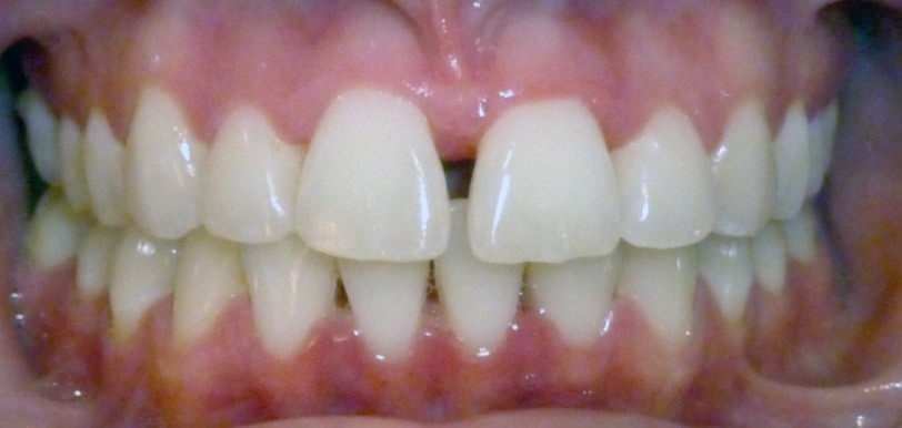Gap between the front teeth before clear aligner treatment at Murray Orthodontics in Palm Beach Gardens