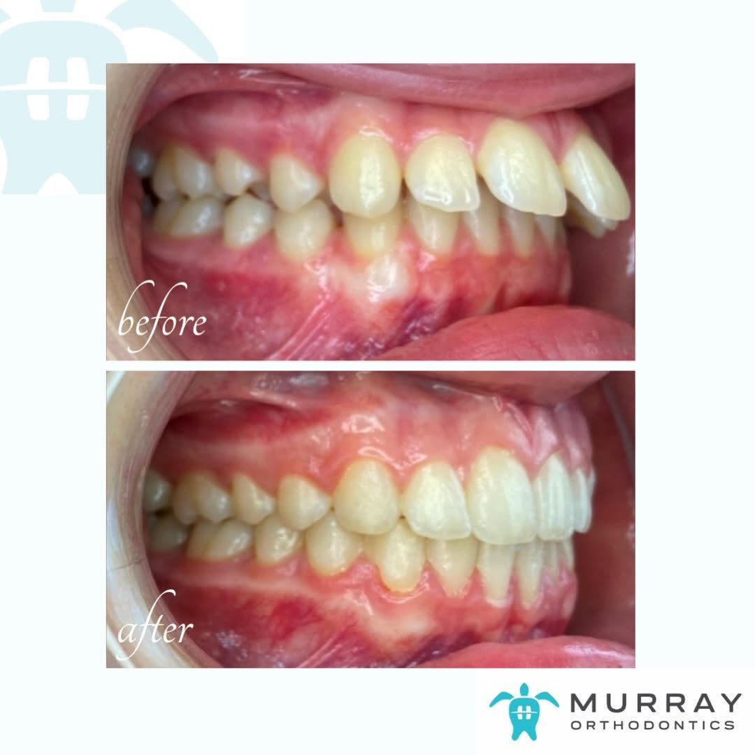 Side view before and after braces at Murray Orthodontics in Palm Beach Gardens, FL, with the upper front teeth brought back into alignment