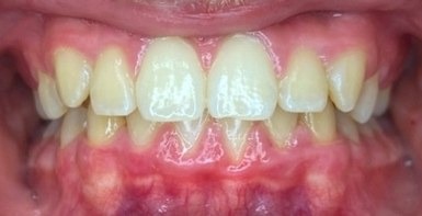 After Phase 1 braces: upper front teeth sitting in front of the lower teeth with the crossbite corrected