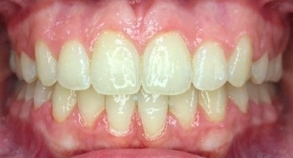 After braces, front view: gaps closed and front teeth even