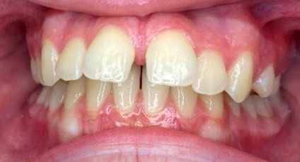 Before braces, front view: gap between the two front teeth and spacing between other teeth