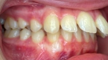 Before braces, side view: upper front teeth angled forward past the lower teeth