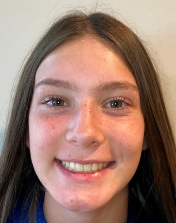 Patient smiling after braces closed the gaps between her teeth, Palm Beach Gardens orthodontist
