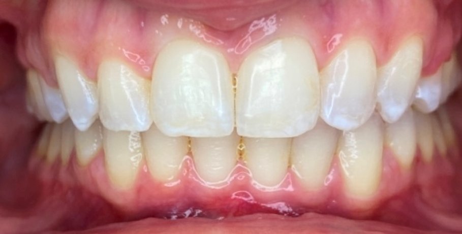 Front view after overbite treatment at Murray Orthodontics showing a level bite with the lower front teeth visible
