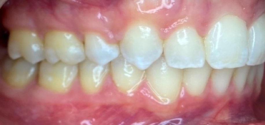 Side view after overbite treatment at Murray Orthodontics showing the front teeth meeting with a normal overlap