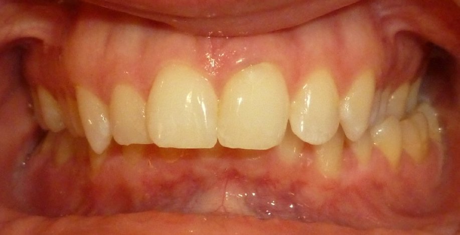 Front view before treatment showing a deep overbite where the upper front teeth cover most of the lower front teeth