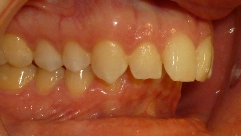 Side view before treatment showing a deep overbite and overjet with the upper front teeth flared forward over the lower teeth