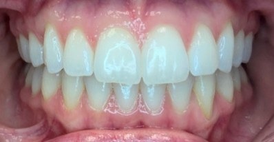 Teeth after clear aligner treatment to broaden a narrow smile, front view