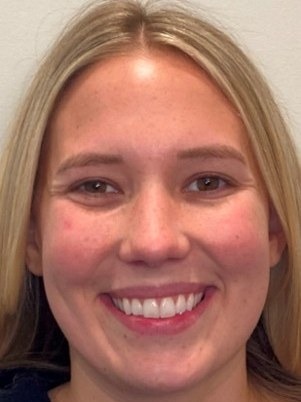 Adult patient before clear aligners, smiling with a narrow smile where the back teeth don't show