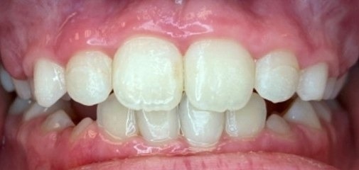 After Phase 1 braces, front view: upper front teeth overlapping the lower teeth with the open bite closed