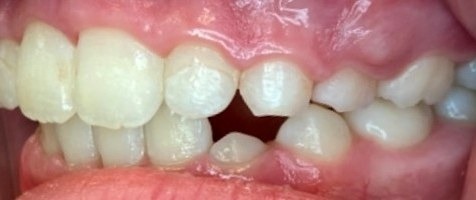 After Phase 1 braces, side view: upper front teeth moved back into line over the lower teeth