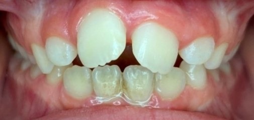 Before Phase 1 braces, front view: upper and lower front teeth not meeting in an anterior open bite from thumb sucking