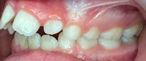 Before Phase 1 braces, side view: upper front teeth protruding forward with a gap between the front teeth