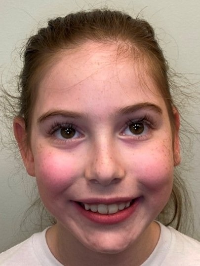 Young patient smiling after Phase 1 braces for an open bite caused by thumb sucking, Palm Beach Gardens