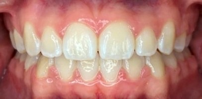 After Iconix braces: straight, evenly spaced teeth with the canines brought into line