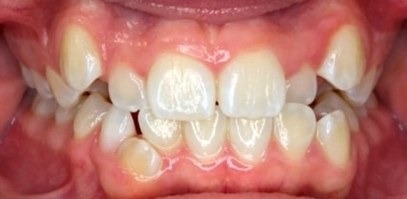 Before Iconix braces: severe crowding with both upper canines blocked out high and out of line