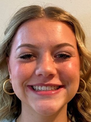 Patient smiling after Iconix champagne braces for severe crowding at Murray Orthodontics in Palm Beach Gardens