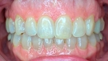 After 16 months of clear aligners: upper and lower front teeth meeting with the open bite closed
