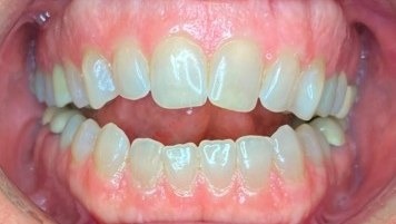 Before clear aligners: severe anterior open bite with a wide gap between the upper and lower front teeth
